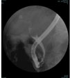内視鏡的逆行性胆道膵管造影検査（ERCP）
