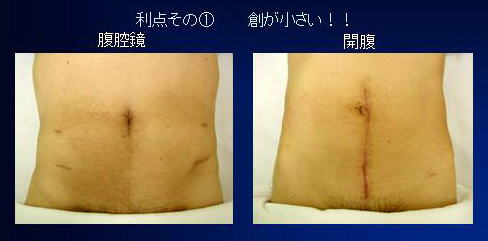 腹腔鏡下大腸がん手術の長所