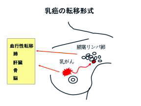 乳癌の転移形式