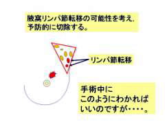 センチネルリンパ節生検
