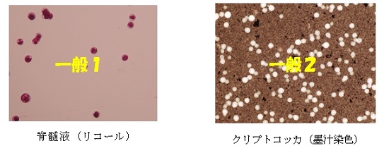脊髄液、クリプトコッカス標本画像